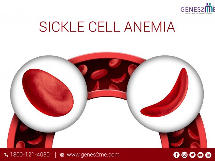 Sickle Cell Anemia & Disease