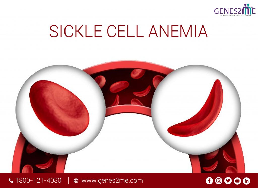 Sickle Cell Anemia