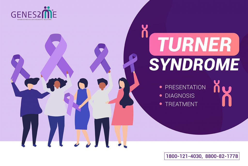 monosomy turner syndrome